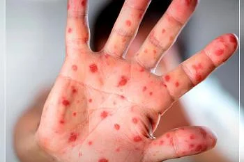 ВНИМАНИЕ, КОРЬ!